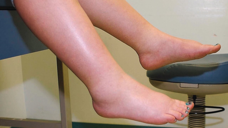 Suy thận độ 1 uống thuốc gì​? Điều trị và phòng ngừa như thế nào? 4