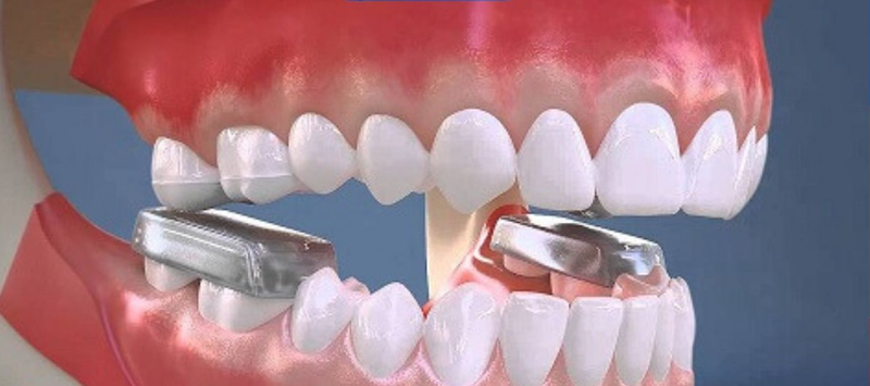 Tác dụng của việc nâng khớp cắn trong niềng răng