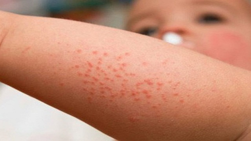 Xuất huyết dưới da là dấu hiệu trong giai đoạn nguy hiểm của sốt xuất huyết