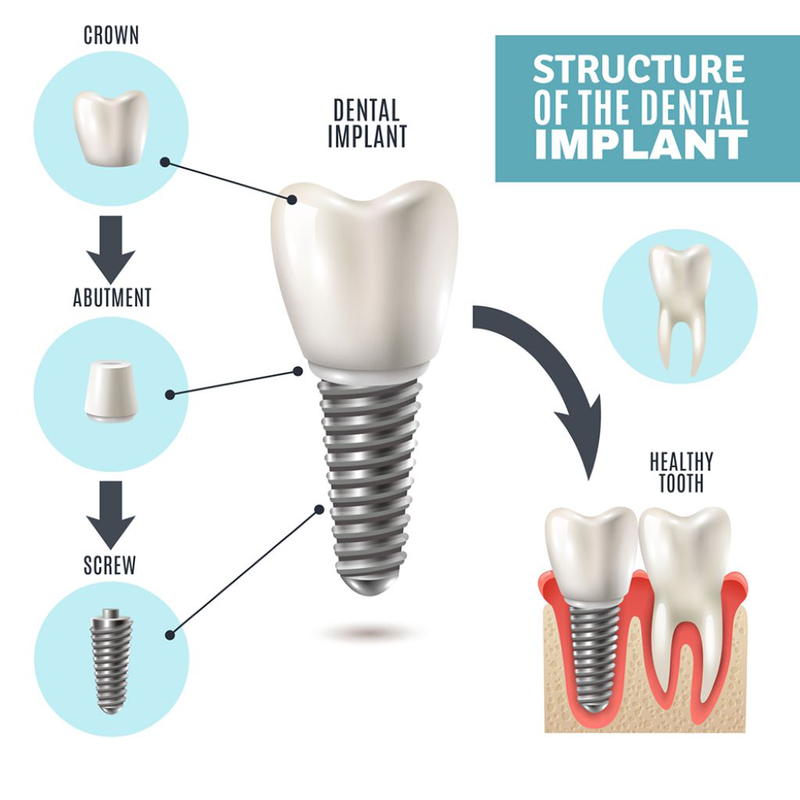 Tác hại của việc trồng răng implant có thể bạn chưa biết? 2
