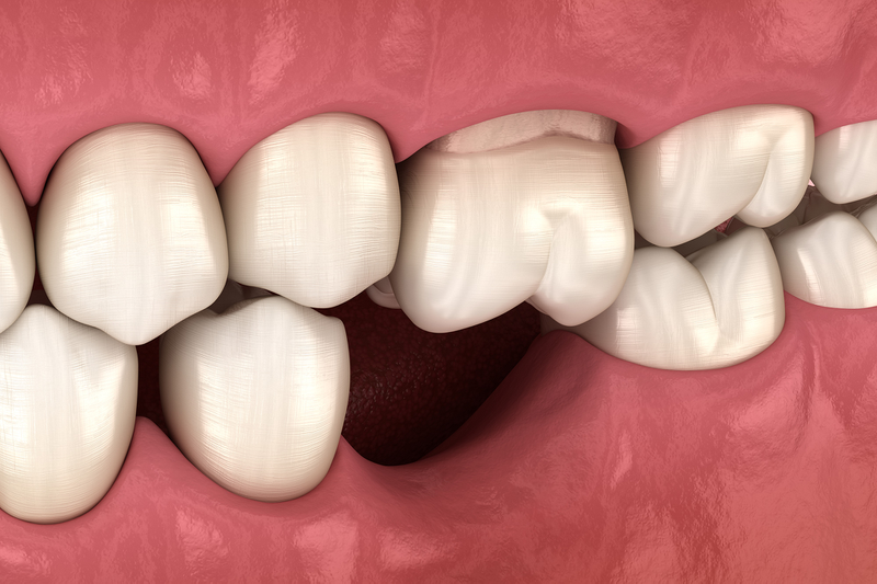 Tác hại của việc trồng răng implant có thể bạn chưa biết? 3