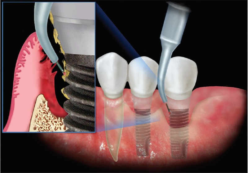 Tác hại của việc trồng răng implant có thể bạn chưa biết? 6