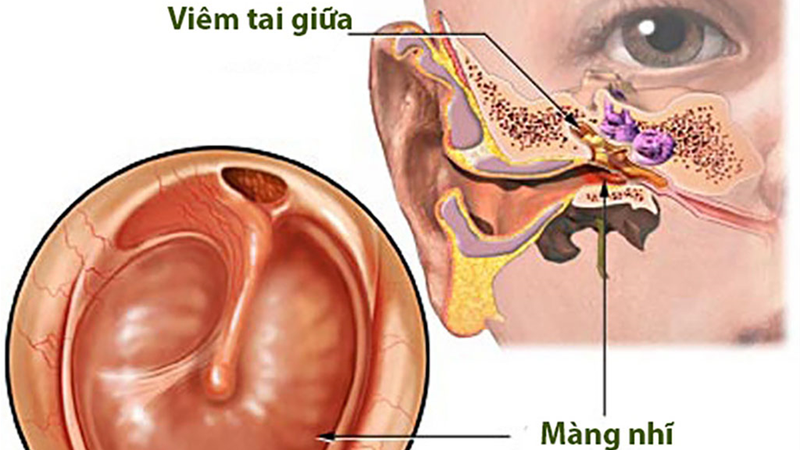 Tắc vòi nhĩ: Nguyên nhân gây ra tình trạng ù tai kéo dài 2