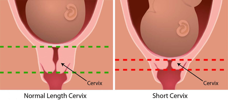 Cổ Tử Cung Không Mở: Nguyên Nhân Và Cách Xử Lý