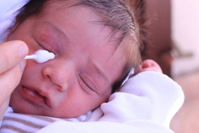 Tại sao mí mắt trẻ sơ sinh nổi gân đỏ và điều này có nguy hiểm không? 2