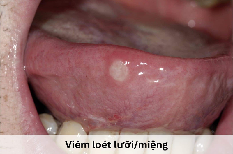 Tại sao trên lưỡi có vết răng? -2