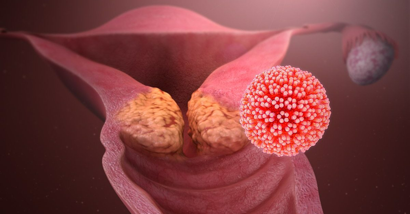 Tạm biệt nỗi lo nhiễm HPV với gel đặt âm đạo Papilocare Gel Vaginal2