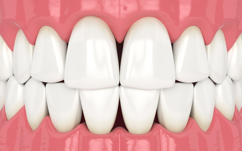 Tam giác đen khi niềng răng là gì? Nguyên nhân và cách khắc phục 2