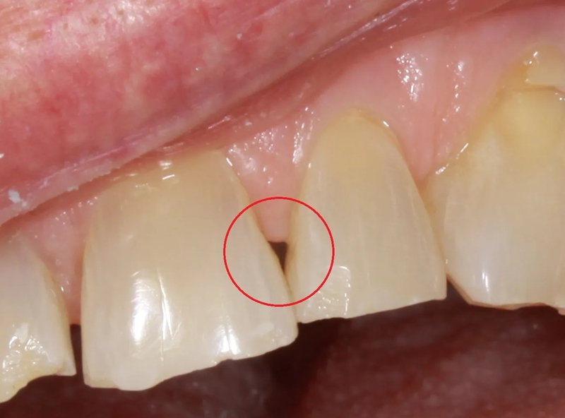 Tam giác đen khi niềng răng là gì? Nguyên nhân và cách khắc phục 1