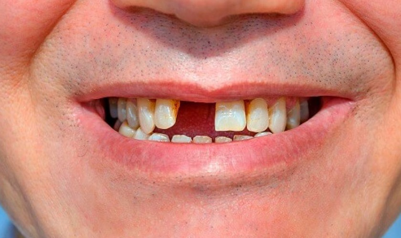 Tam giác nướu sau niềng răng: Nguyên nhân và cách khắc phục 4