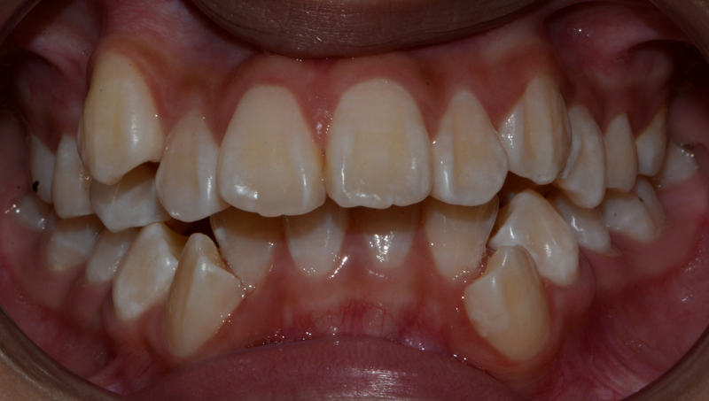 Tam giác nướu sau niềng răng: Nguyên nhân và cách khắc phục 2