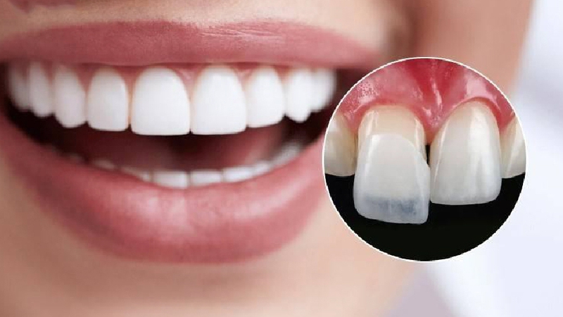 Tam giác nướu sau niềng răng: Nguyên nhân và cách khắc phục 5