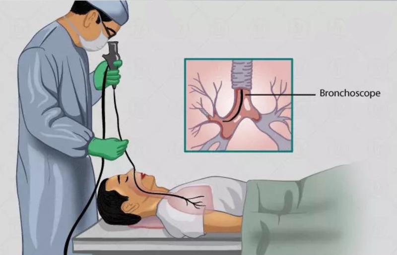 Tầm soát ung thư phổi gồm những phương pháp nào?