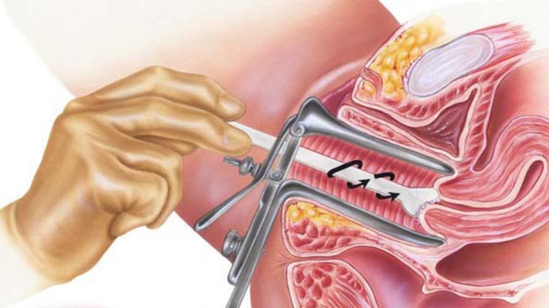 Tân sinh là gì? Tìm hiểu về bệnh lý tân sinh biểu mô cổ tử cung 4