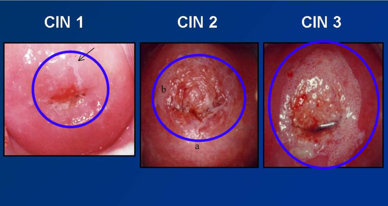 Tân sinh là gì? Tìm hiểu về bệnh lý tân sinh biểu mô cổ tử cung 2