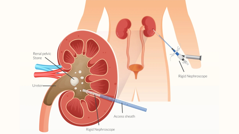 Tán sỏi qua da là một phương pháp can thiệp ngoại khoa tối thiểu