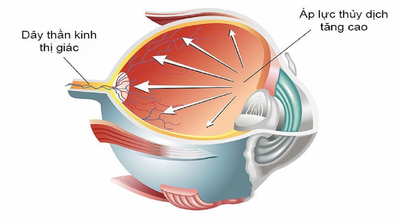 Tăng huyết áp mắt: Nguyên nhân và cách điều trị 1