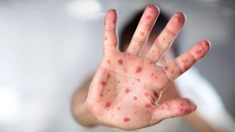 Tay chân miệng bội nhiễm: Dấu hiệu cảnh báo, mức độ nguy hiểm và cách chăm sóc đúng cách 2