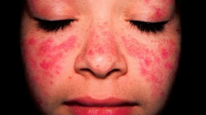 Phát ban đỏ là một trong những triệu chứng của Lupus ban đỏ