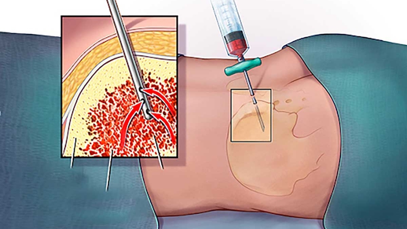 Tế bào mast hệ thống: Triệu chứng, nguyên nhân, chuẩn đoán và điều trị 3