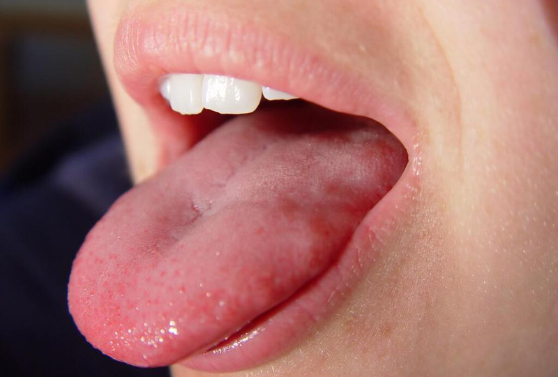 Tê lưỡi có thể liên quan tới tổn thương thần kinh