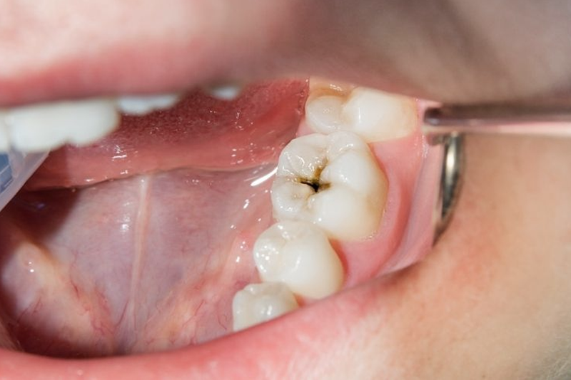 Thắc mắc: Trám răng là gì? Khi nào cần phải trám răng? 1