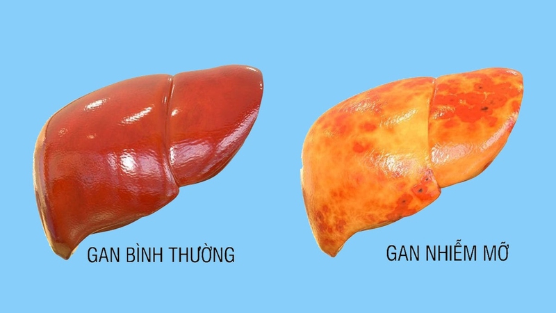 Tham khảo chế độ ăn cho người mỡ máu: Nên và không nên ăn gì 2