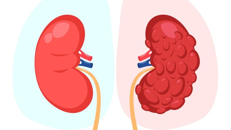 Phân biệt thận đa nang và nang thận 3