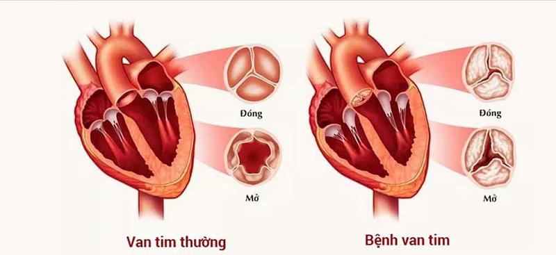 4. Mức độ nguy hiểm của hở van tim 2 lá 1/4