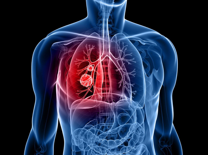Thế nào là chụp CT phổi liều thấp? 1
