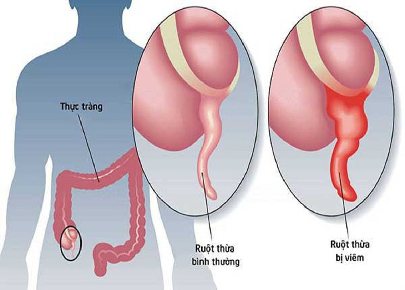 Thế nào là phản ứng dội (Blumberg)? -3