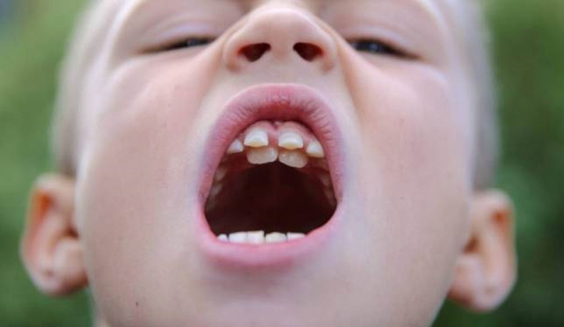 Thiếu răng bẩm sinh có nguy hiểm không? Cách xử lý tình trạng này thế nào? 2
