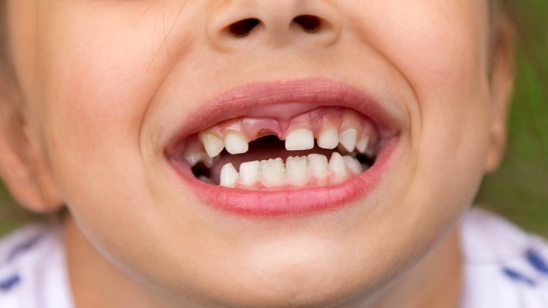 Thiếu răng bẩm sinh có nguy hiểm không? Cách xử lý tình trạng này thế nào? 3