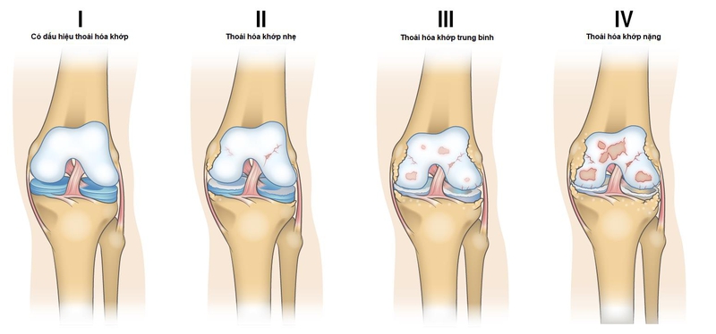 thoái hóa khớp gối 1.jpg