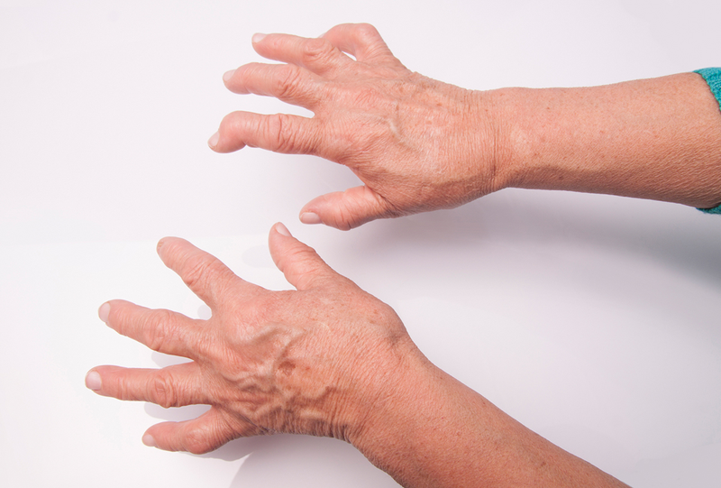 Thoái hoá khớp ngón tay là gì? Nguyên nhân nhân gây bệnh, chẩn đoán và điều trị 4