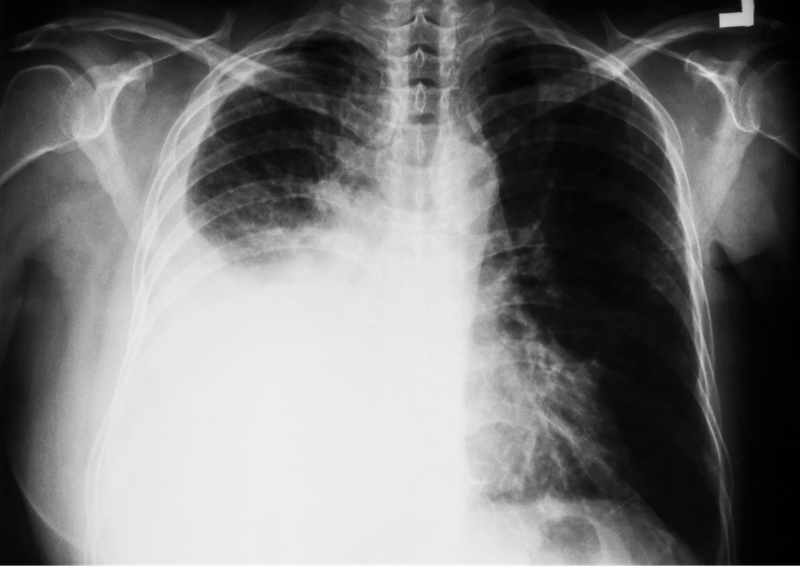 Thời gian điều trị tràn dịch màng phổi bao lâu? 2