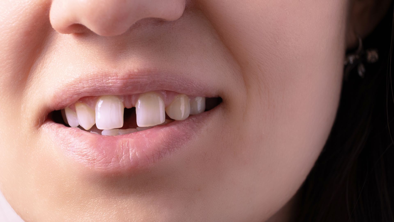 Thời gian hàn răng cửa thưa là bao lâu? Cần lưu ý những gì? 1