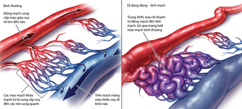 Thông động tĩnh mạch: Khái niệm, nguyên nhân và điều trị 0