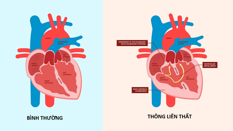 Thông liên thất phần màng 4mm là gì? Có nguy hiểm không? 1