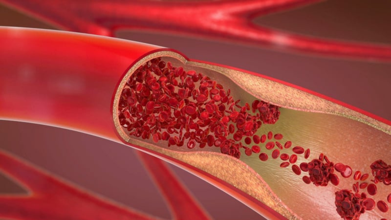 Thrombophilia: Nguyên nhân và cách phòng ngừa hội chứng tăng đông máu 1