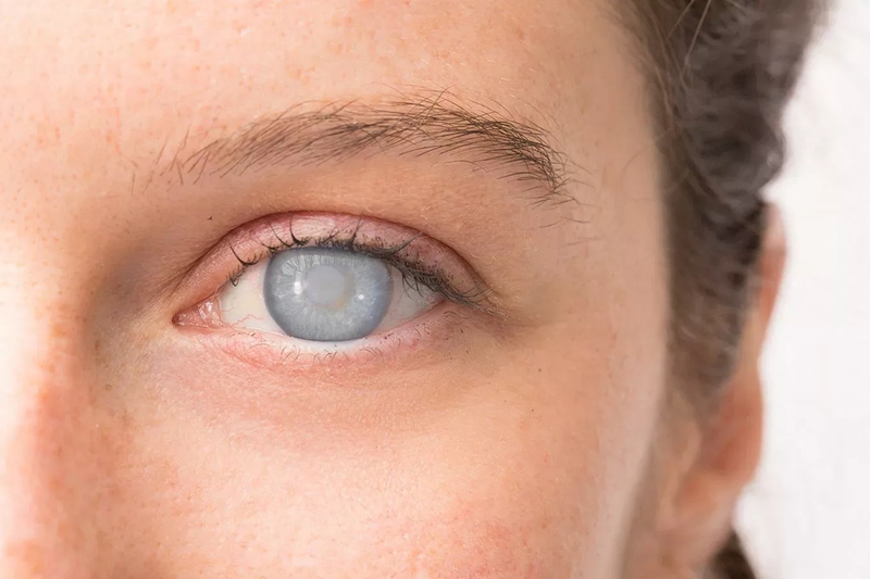 Thuật ngữ Cataract là gì? Người bị mắc bệnh Cataract có nguy hiểm không 1