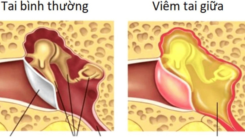 Thủng màng nhĩ có chữa được không​? Thủng màng nhĩ do đâu? 3