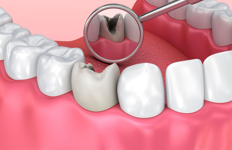 Đặt thuốc diệt tủy răng có đau không? Những trường hợp nào cần chữa tủy răng1