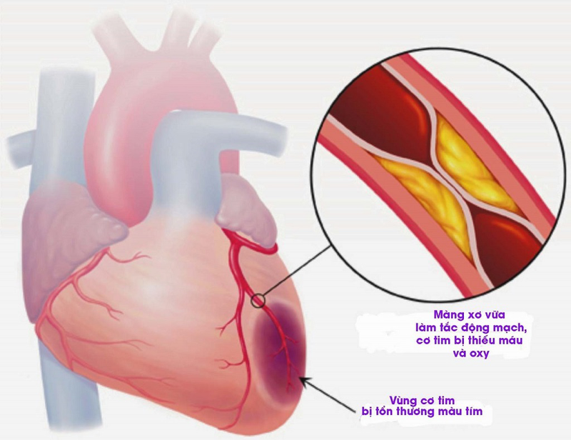 Thuốc điều trị nhồi máu cơ tim gồm những loại nào? Cách sử dụng thuốc tốt nhất 1