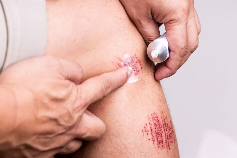 Thuốc mỡ kháng sinh bôi vết thương hở và những điều bạn cần biết 3