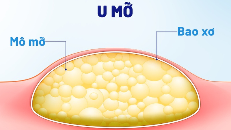 thuoc-tieu-u-mo1.jpg