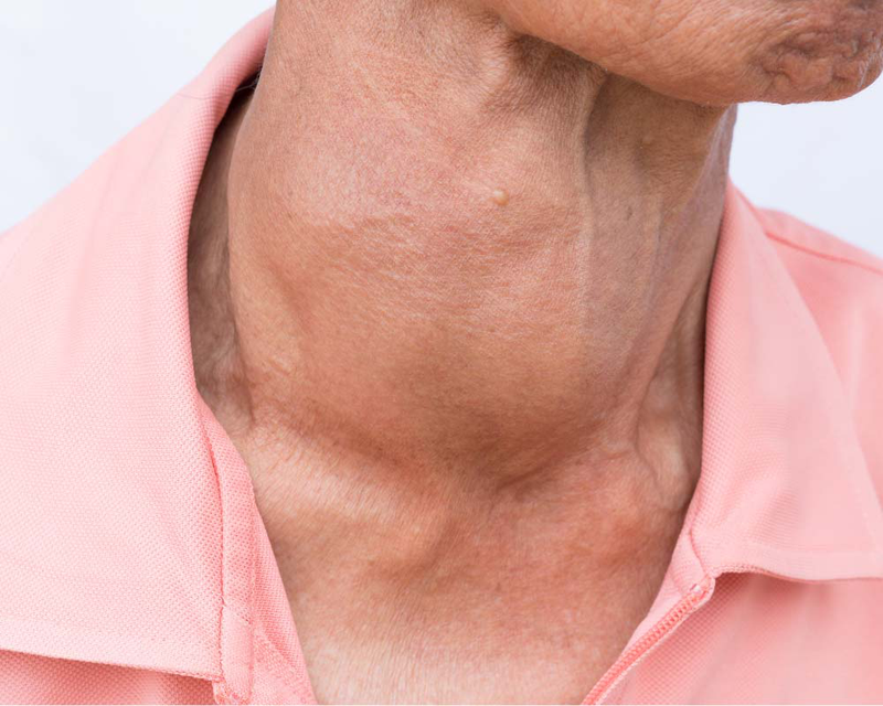 Thyroid là gì và những bệnh lý Thyroid nào thường gặp? 3