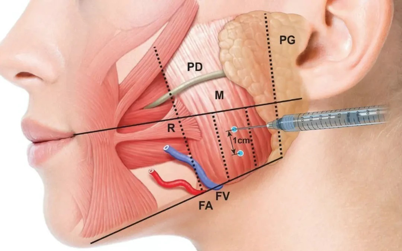 Tiêm botox gọn hàm​: Quy trình, rủi ro và lưu ý khi thực hiện 1