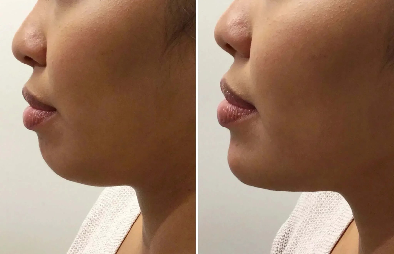 Góc làm đẹp: Tiêm filler cằm bao lâu thì đẹp tự nhiên 4