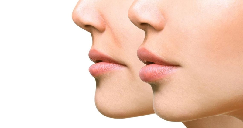 Tiêm filler môi có ảnh hưởng gì không? Cần lưu ý những gì khi lựa chọn tiêm filler môi? 2
